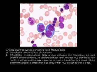 Anemia diseritropoyética congénita tipo I. Médula ósea.
A. Eritroblastos policromáticos binucleados.
B. Eritroblastos ortocromáticos. Estos grupos celulares son frecuentes en esta
anemia diseritropoyética. Se caracterizan por tener núcleos muy picnóticos y un
contorno citoplasmático muy impreciso, lo que impide determinar si son células
bi o multinucleares o simplemente se encuentran muy cercanas unas a otras.

 