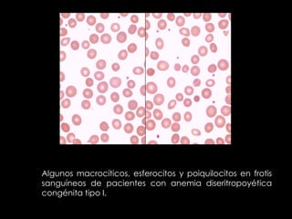 Algunos macrocíticos, esferocitos y poiquilocitos en frotis
sanguíneos de pacientes con anemia diseritropoyética
congénita tipo I.

 
