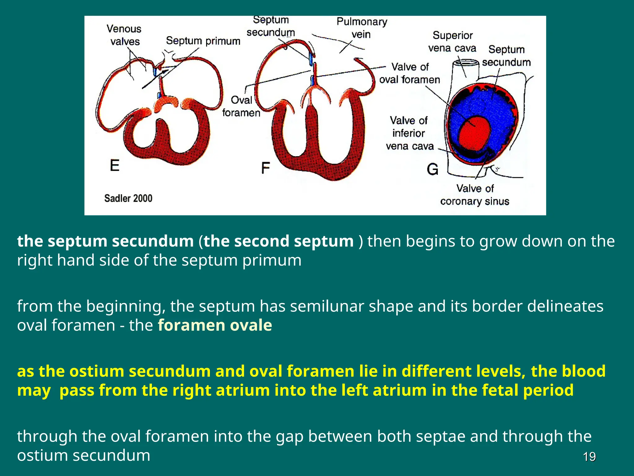 the septum secundum (the second septum ) then begins to grow down on the
right hand side of the septum primum
from the beginning, the septum has semilunar shape and its border delineates
oval foramen - the foramen ovale
as the ostium secundum and oval foramen lie in different levels, the blood
may pass from the right atrium into the left atrium in the fetal period
through the oval foramen into the gap between both septae and through the
ostium secundum 19
19
 
