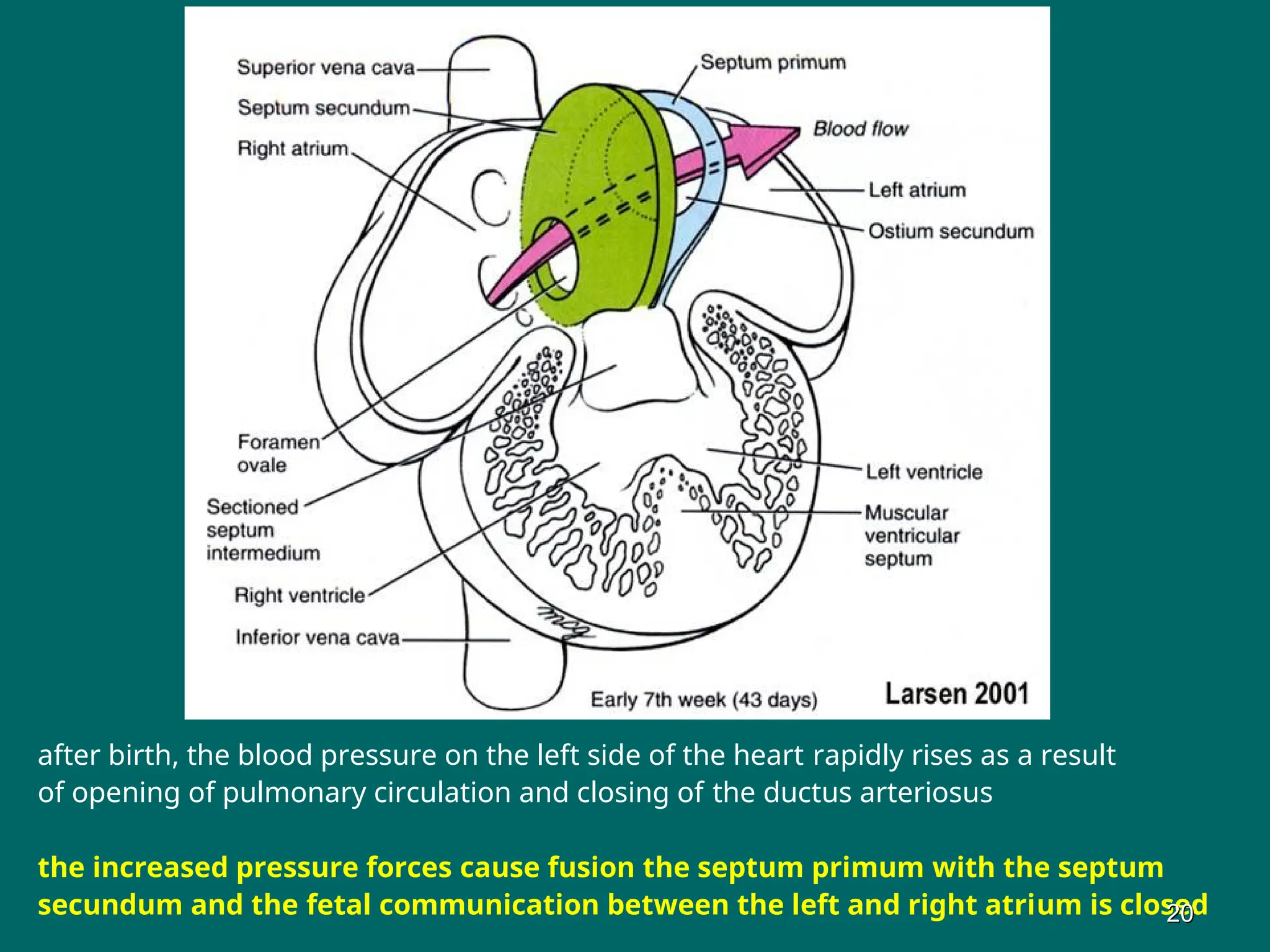 after birth, the blood pressure on the left side of the heart rapidly rises as a result
of opening of pulmonary circulation and closing of the ductus arteriosus
the increased pressure forces cause fusion the septum primum with the septum
secundum and the fetal communication between the left and right atrium is closed
20
20
 