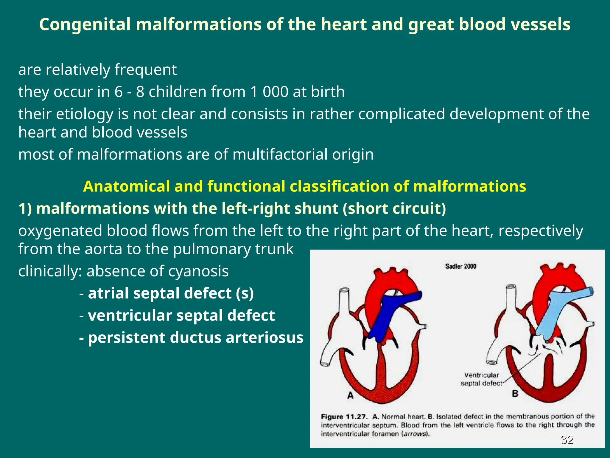 Congenital malformations of the heart and great blood vessels
are relatively frequent
they occur in 6 - 8 children from 1 000 at birth
their etiology is not clear and consists in rather complicated development of the
heart and blood vessels
most of malformations are of multifactorial origin
Anatomical and functional classification of malformations
1) malformations with the left-right shunt (short circuit)
oxygenated blood flows from the left to the right part of the heart, respectively
from the aorta to the pulmonary trunk
clinically: absence of cyanosis
- atrial septal defect (s)
- ventricular septal defect
- persistent ductus arteriosus
32
32
 