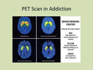 PET Scan in Addiction
 