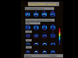 Post-Chronic Amphetamine (10 days) Pre-Amphetamine/Control Striatal FDOPA Activity 4 weeks 6 months 1 year 2 years Superior   Inferior 