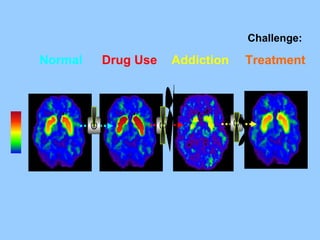 Drug Use Addiction Treatment Normal Challenge: 