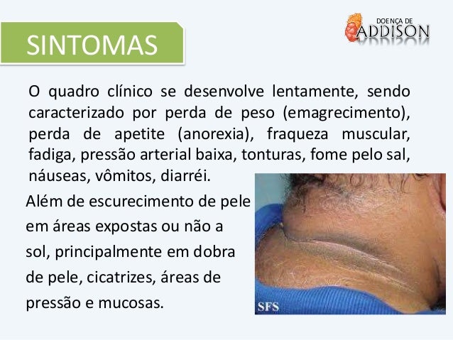 Doença de Addison