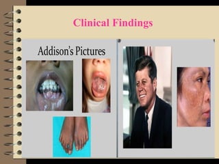 Addison's Disease powerpoint | PPT