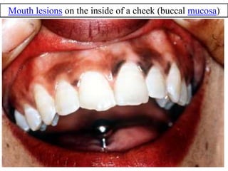 Mouth lesions on the inside of a cheek (buccal mucosa)
 