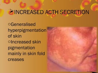 addison disease and its management adults.ppt
