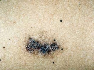 Addison disease by dr shahjada selim | PPTX