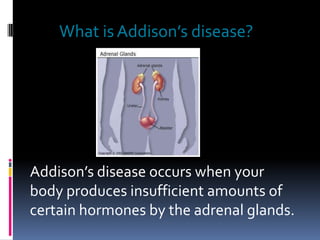 What is Addison’s disease?




Addison’s disease occurs when your
body produces insufficient amounts of
certain hormones by the adrenal glands.
 