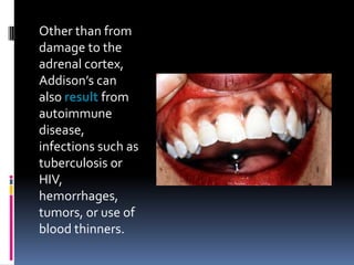 Other than from
damage to the
adrenal cortex,
Addison’s can
also result from
autoimmune
disease,
infections such as
tuberculosis or
HIV,
hemorrhages,
tumors, or use of
blood thinners.
 