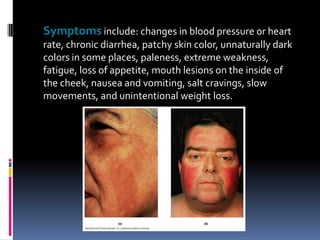 Symptoms include: changes in blood pressure or heart
rate, chronic diarrhea, patchy skin color, unnaturally dark
colors in some places, paleness, extreme weakness,
fatigue, loss of appetite, mouth lesions on the inside of
the cheek, nausea and vomiting, salt cravings, slow
movements, and unintentional weight loss.
 