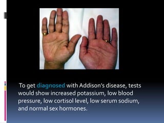 To get diagnosed with Addison’s disease, tests
would show increased potassium, low blood
pressure, low cortisol level, low serum sodium,
and normal sex hormones.
 