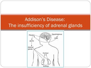 Addison’s Disease:
The insufficiency of adrenal glands
 