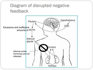 Diagram of disrupted negative
feedback
Excessive and ineffective
amounts of
Adrenal cortex
hormones are not
released
 