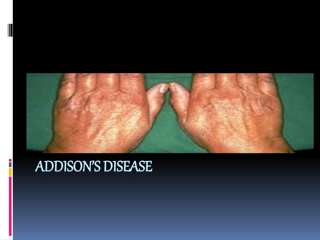 Addison’s disease