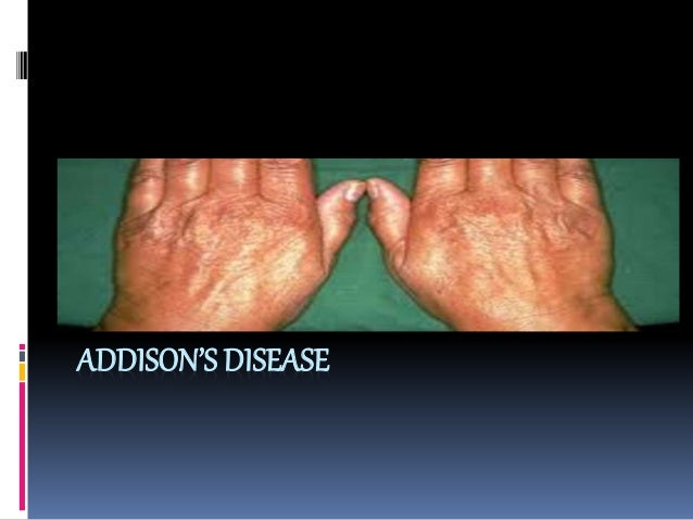 Addison Disease