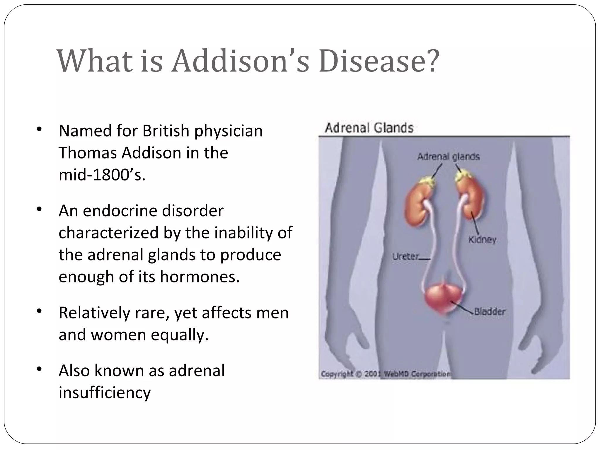 Addison's Disease | PPT