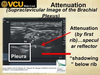 Attenuation
(by first
rib)…specul
ar reflector
“shadowing
” below rib
Pleura
(Supraclavicular Image of the Brachial
Plexus...