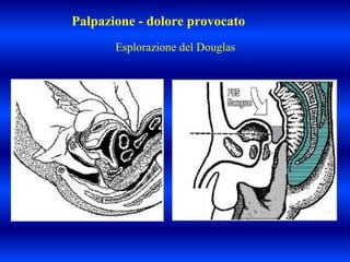 Palpazione - dolore provocato
Esplorazione del Douglas
 