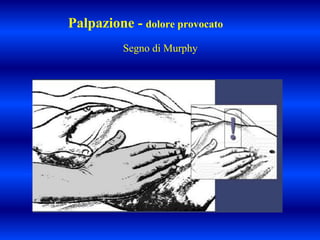 Palpazione - dolore provocato
Segno di Murphy
 