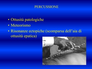 PERCUSSIONE
• Ottusità patologiche
• Meteorismo
• Risonanze ectopiche (scomparsa dell’aia di
ottusità epatica)
 