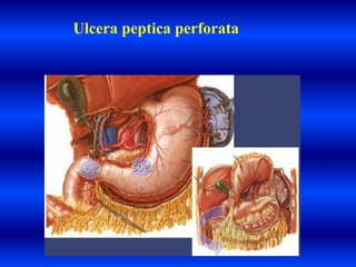 Ulcera peptica perforata
 