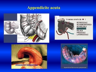 Appendicite acuta
 