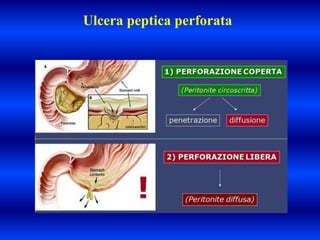 Ulcera peptica perforata
 