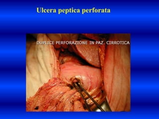 Ulcera peptica perforata
 