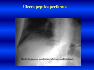 Ulcera peptica perforata
 