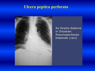 Ulcera peptica perforata
 