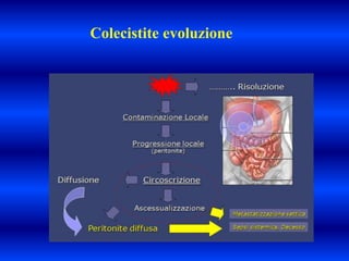 Colecistite evoluzione
 