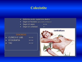 Colecistite
 