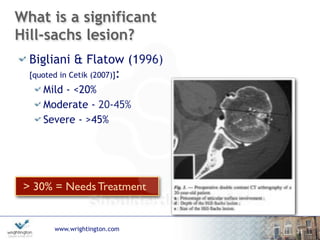 www.wrightington.com
What is a significant
Hill-sachs lesion?
Bigliani & Flatow (1996)  
[quoted in Cetik (2007)]:
Mild - <20%
Moderate - 20-45%
Severe - >45%
11
> 30% = Needs Treatment
 