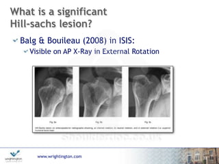 www.wrightington.com
What is a significant
Hill-sachs lesion?
Balg & Bouileau (2008) in ISIS:
Visible on AP X-Ray in External Rotation
12
 