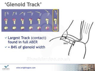 www.wrightington.com
Largest Track (contact)
found in full ABER
= 84% of glenoid width
19
‘Glenoid Track’
 