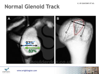 www.wrightington.com
Normal Glenoid Track
22
83%
 