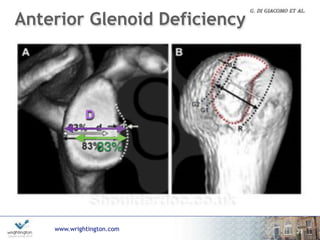 www.wrightington.com
Anterior Glenoid Deficiency
23
D
83%
 