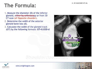www.wrightington.com
The Formula:
24
1. Measure the diameter (D) of the inferior
glenoid, either by arthroscopy or from 3D
CT scan (of Opposite shoulder).
2. Determine the width of the anterior
glenoid bone loss (d).
3. Calculate the width of the glenoid track
(GT) by the following formula: GT=0.83D-d
4. Calculate the width of the HSI, which is
the width of the Hill-Sachs lesion (HS) plus
the width of the bone bridge (BB) between
the rotator cuff attachments and the
lateral aspect of the Hill-Sachs lesion:  
HSI = HS + BB.
5. If HSI > GT, the HS is off track, or
engaging. If HSI < GT, the HS is on track, or
non-engaging.
D
83%
 