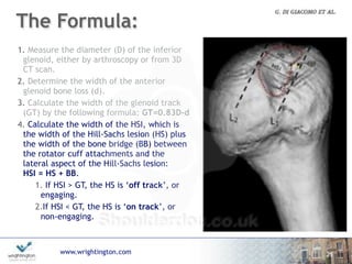 www.wrightington.com
The Formula:
25
1. Measure the diameter (D) of the inferior
glenoid, either by arthroscopy or from 3D
CT scan.
2. Determine the width of the anterior
glenoid bone loss (d).
3. Calculate the width of the glenoid track
(GT) by the following formula: GT=0.83D-d
4. Calculate the width of the HSI, which is
the width of the Hill-Sachs lesion (HS) plus
the width of the bone bridge (BB) between
the rotator cuff attachments and the
lateral aspect of the Hill-Sachs lesion:  
HSI = HS + BB.
1. If HSI > GT, the HS is ‘off track’, or
engaging.
2.If HSI < GT, the HS is ‘on track’, or
non-engaging.
 
