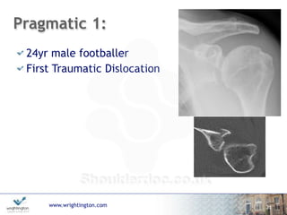 www.wrightington.com
Pragmatic 1:
24yr male footballer
First Traumatic Dislocation
31
 