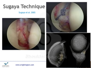 www.wrightington.com
Sugaya Technique
Sugaya et al. 2005
 