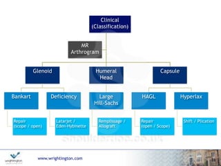 www.wrightington.com
Clinical
(Classification)
MR
Arthrogram
Glenoid
Bankart
Repair 
(scope / open)
Deficiency
Latarjet / 
Eden-Hybinette
Humeral
Head
Large 
Hill-Sachs
Remplissage / 
Allograft
Capsule
HAGL
Repair 
(open / Scope)
Hyperlax
Shift / Plication
 
