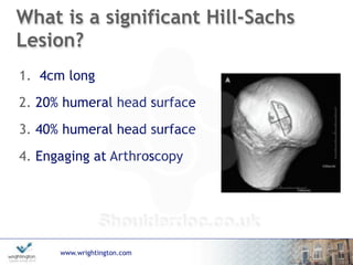 www.wrightington.com
What is a significant Hill-Sachs
Lesion?
1. 4cm long
2. 20% humeral head surface
3. 40% humeral head surface
4. Engaging at Arthroscopy
 