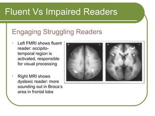 Fluent Vs Impaired Readers Engaging Struggling Readers  Left FMRI shows fluent reader: occipito-temporal region is activated, responsible for visual processing Right MRI shows dyslexic reader: more sounding out in Broca’s area in frontal lobe 
