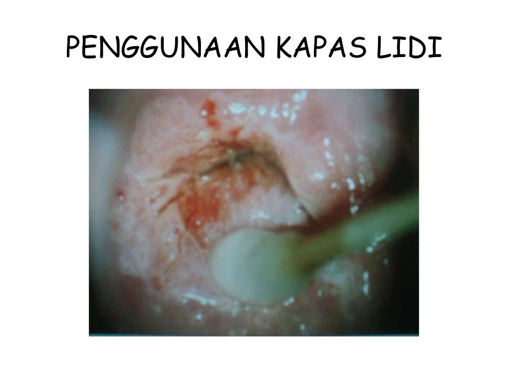 screening ca servix metode IVA screening ca servix metode IVA