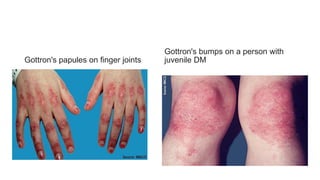 Gottron's papules on finger joints
Gottron's bumps on a person with
juvenile DM
 