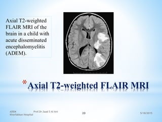 5/18/2015
ADEM Prof.Dr.Saad S Al Ani
Khorfakkan Hospital
20
*Axial T2-weighted FLAIR MRI
Axial T2-weighted
FLAIR MRI of the
brain in a child with
acute disseminated
encephalomyelitis
(ADEM).
 