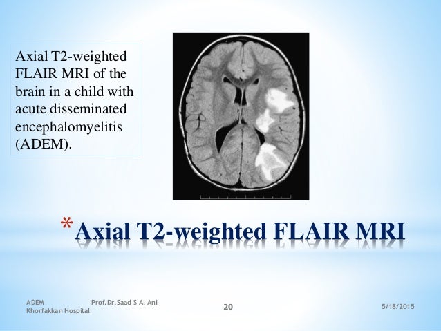 5/18/2015
ADEM Prof.Dr.Saad S Al Ani
Khorfakkan Hospital
20
*Axial T2-weighted FLAIR MRI
Axial T2-weighted
FLAIR MRI of th...